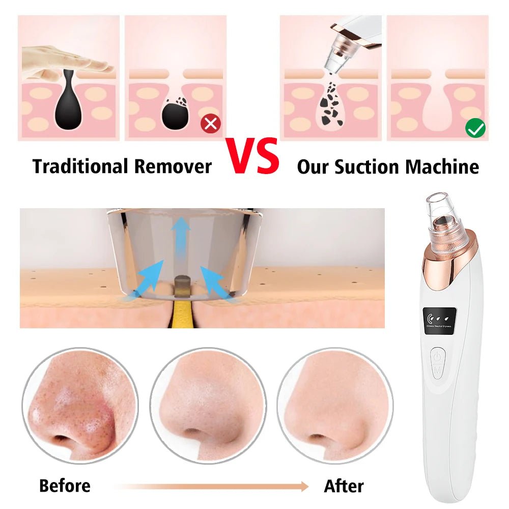 Cat Shop Boys - Electric Vacuum Suction Blackhead Remover Facial Pore Cleaner Comedone Spot Acne Pimple Blackhead Extractor USB Rechargeable