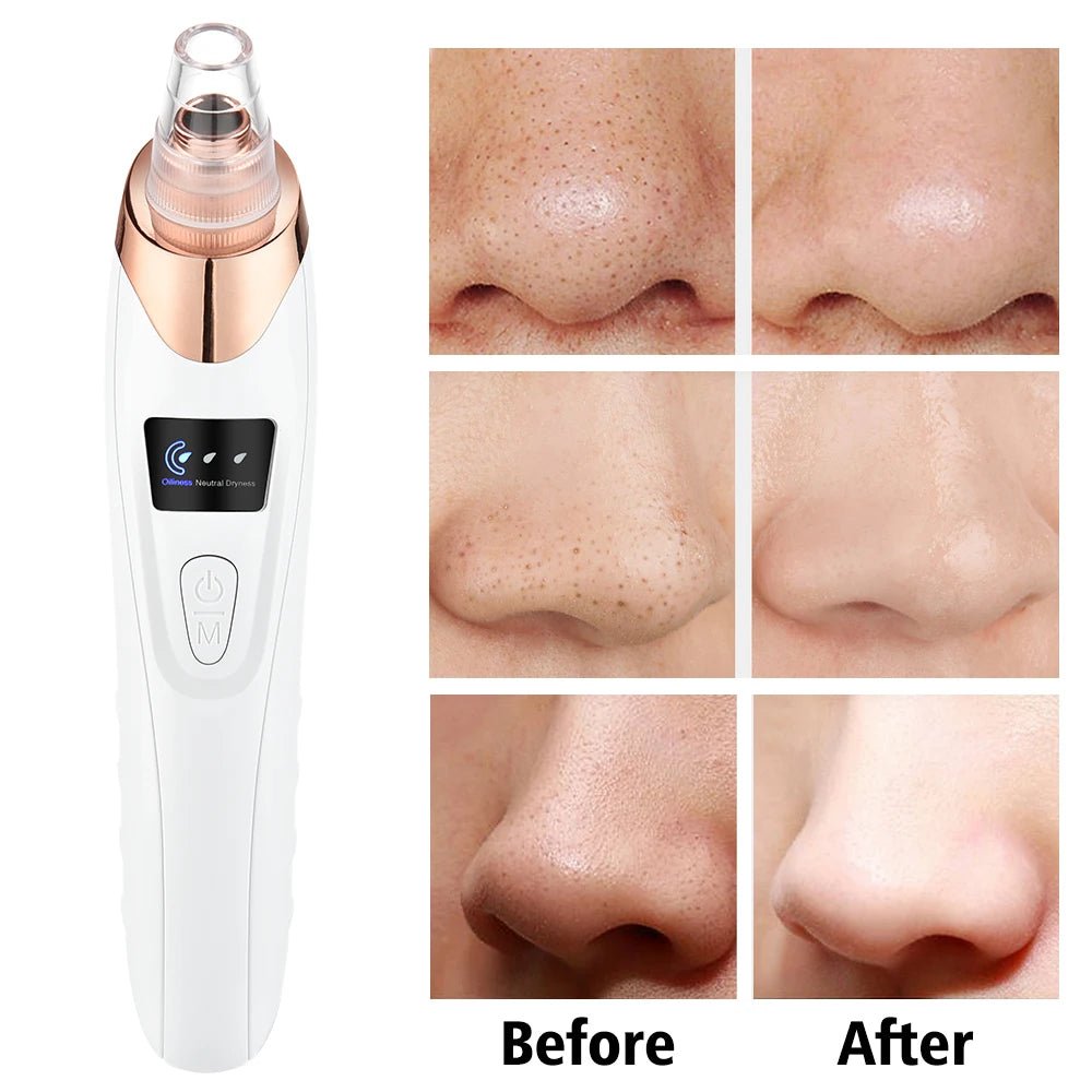 Cat Shop Boys - Electric Vacuum Suction Blackhead Remover Facial Pore Cleaner Comedone Spot Acne Pimple Blackhead Extractor USB Rechargeable